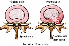 Spinal Disorders